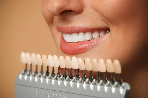 Sorriso perfetto con trattamenti di estetica dentale — Studio Odontoiatrico Mengoni